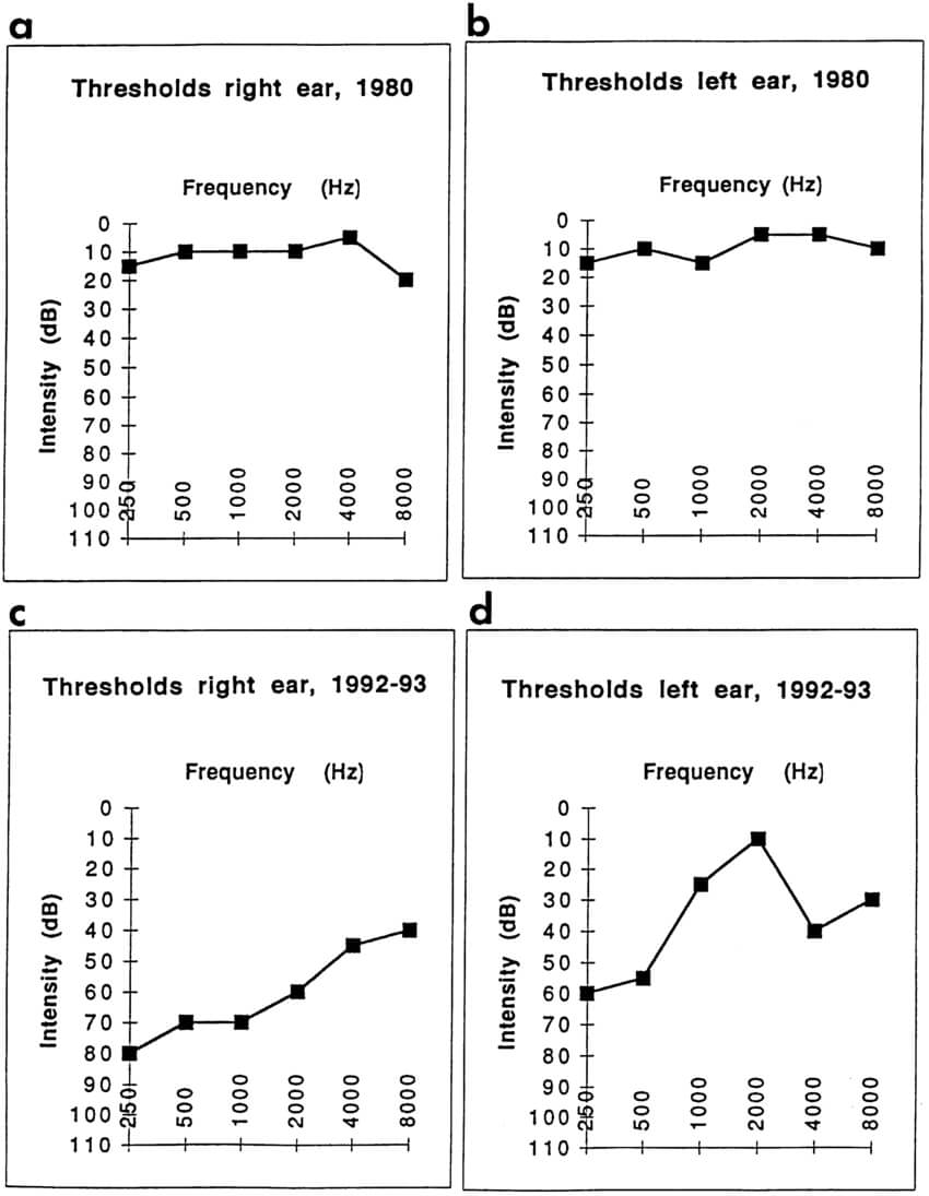 Audiograms Of Patient Al In 1980 (A And B) And In 1992 1993 In Blank Audiogram Template Download